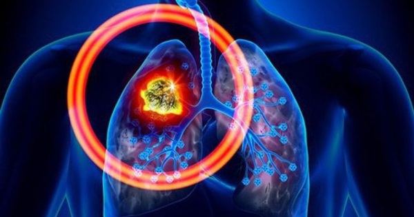 Sàng lọc ung thư phổi bằng CT liều thấp tại Sông Thương